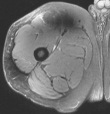 Figure 4 for case rectus femoris indirect head proximal myotendinous junction tear with hematoma( RID2698 )